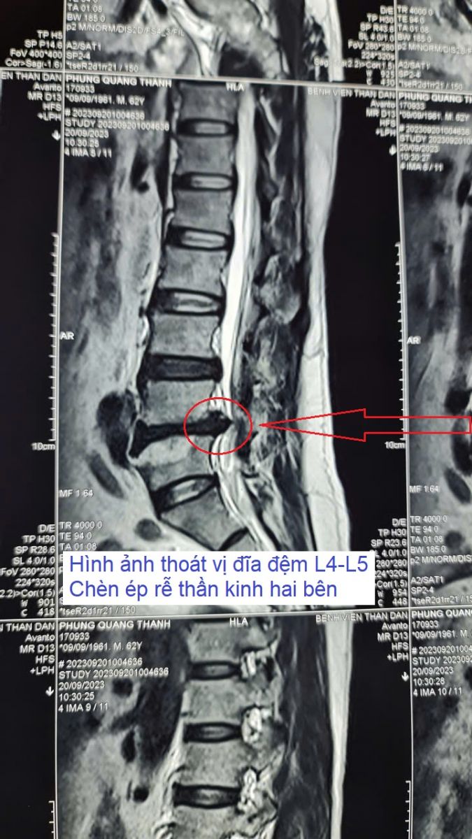 Thoát vị đĩa đệm chèn ép dây thần kinh